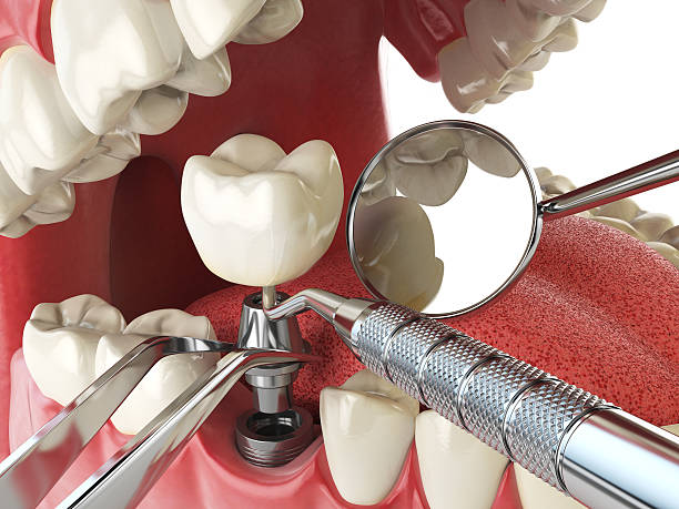 Best Emergency Wisdom Teeth Removal in Mitchell, NE