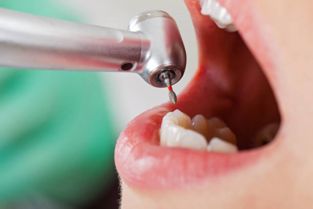 Best Emergency Tooth Extraction in Mitchell, NE